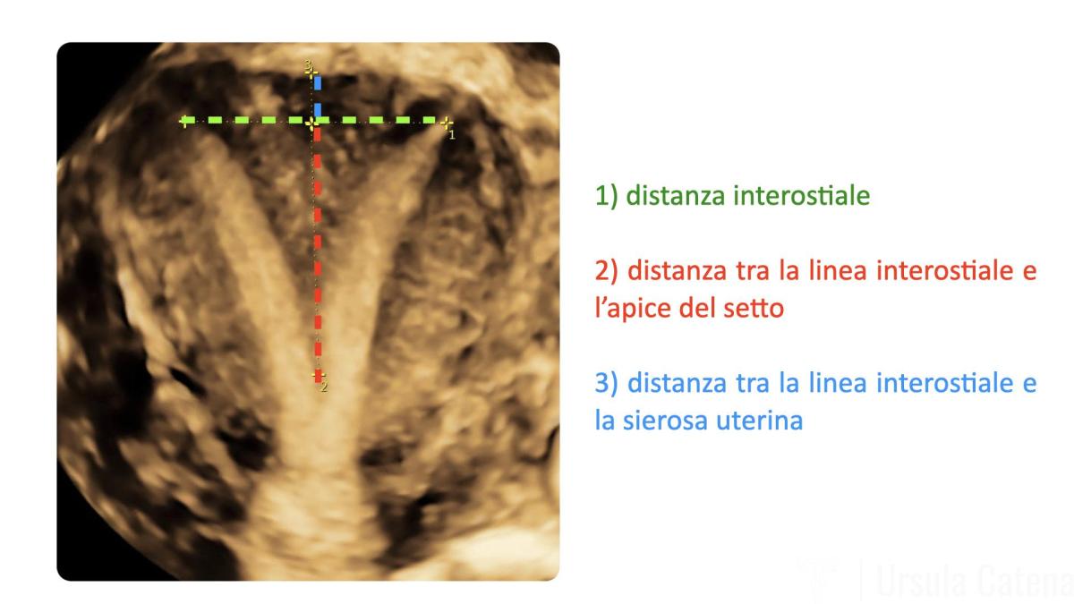 2-eco-3D-setto-uterino001