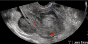 4-eco-post-embolizzazione